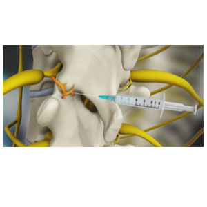 Medial Branch Nerve Block