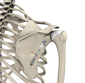 Shoulder Fracture Care